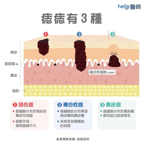 痣為什麼會凸起來|痣形成的原因？痣長毛、痣變多變大是痣病變？5招判。